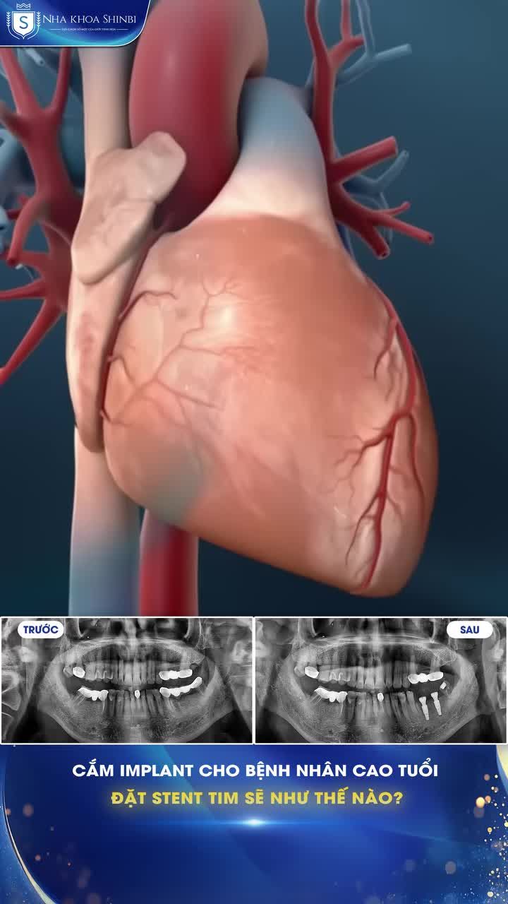 73 tuổi, có stent tim – liệu còn có thể cắm implant an toàn?