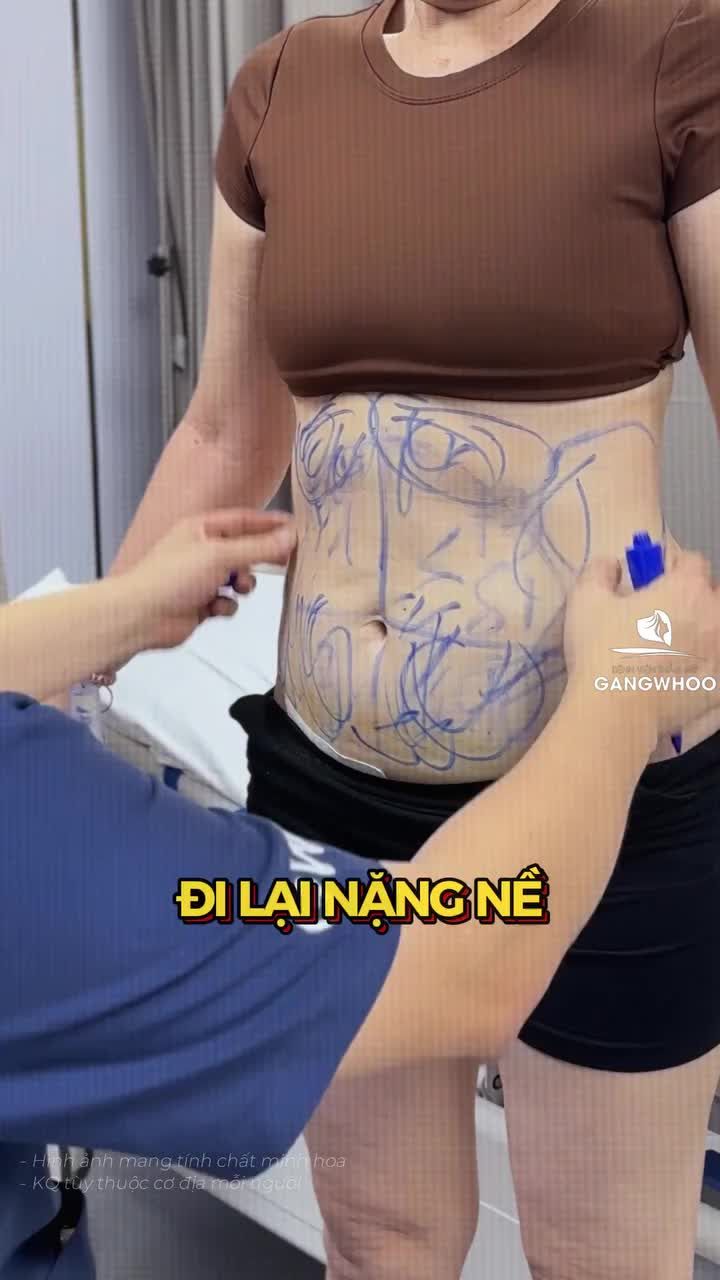 Vòng eo phẳng phiu sau 60 phút giảm mỡ, kết quả ngọt ngào dành cho khách hàng đã lên chức "bà ngoại"