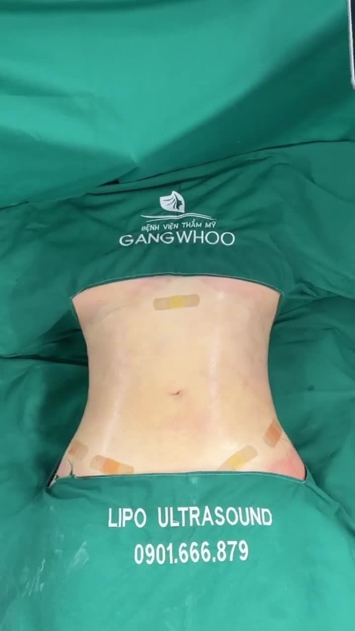 HÀNH TRÌNH GIẢM MỠ BỤNG CỦA CHỊ H. TẠI GANGWHOO – EO THON GỌN, SĂN CHẮC CHỈ SAU 60 PHÚT!
