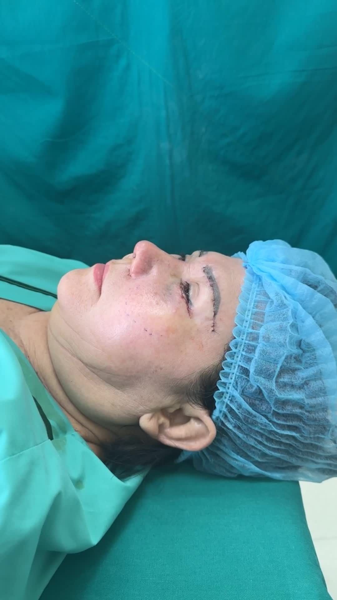 Case Combo Midface ( căng cơ tầng mặt giữa) + Treo cung chân mày + Nâng mũi cấu trúc sửa lại vừa hoàn thành!!