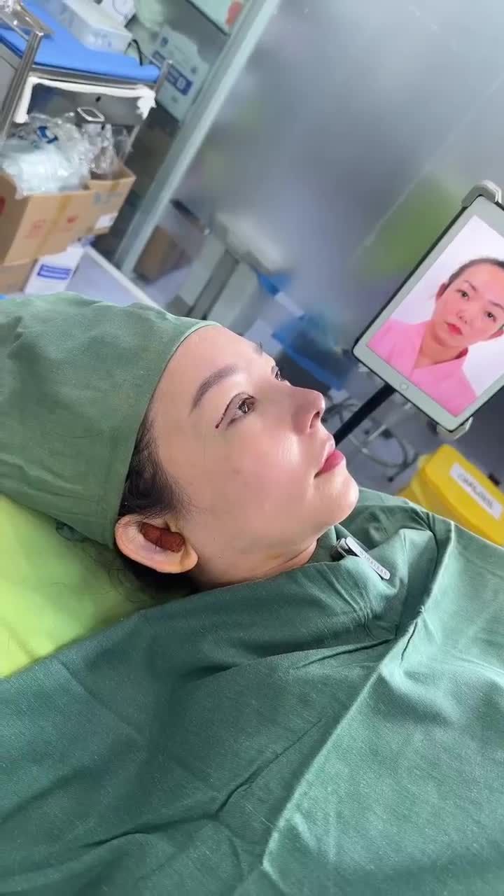 KẾT QUẢ SAU KHI NÂNG MŨI VÀ CẮT MÍ MẮT KH: BÍCH NGÂN (AN GIANG)