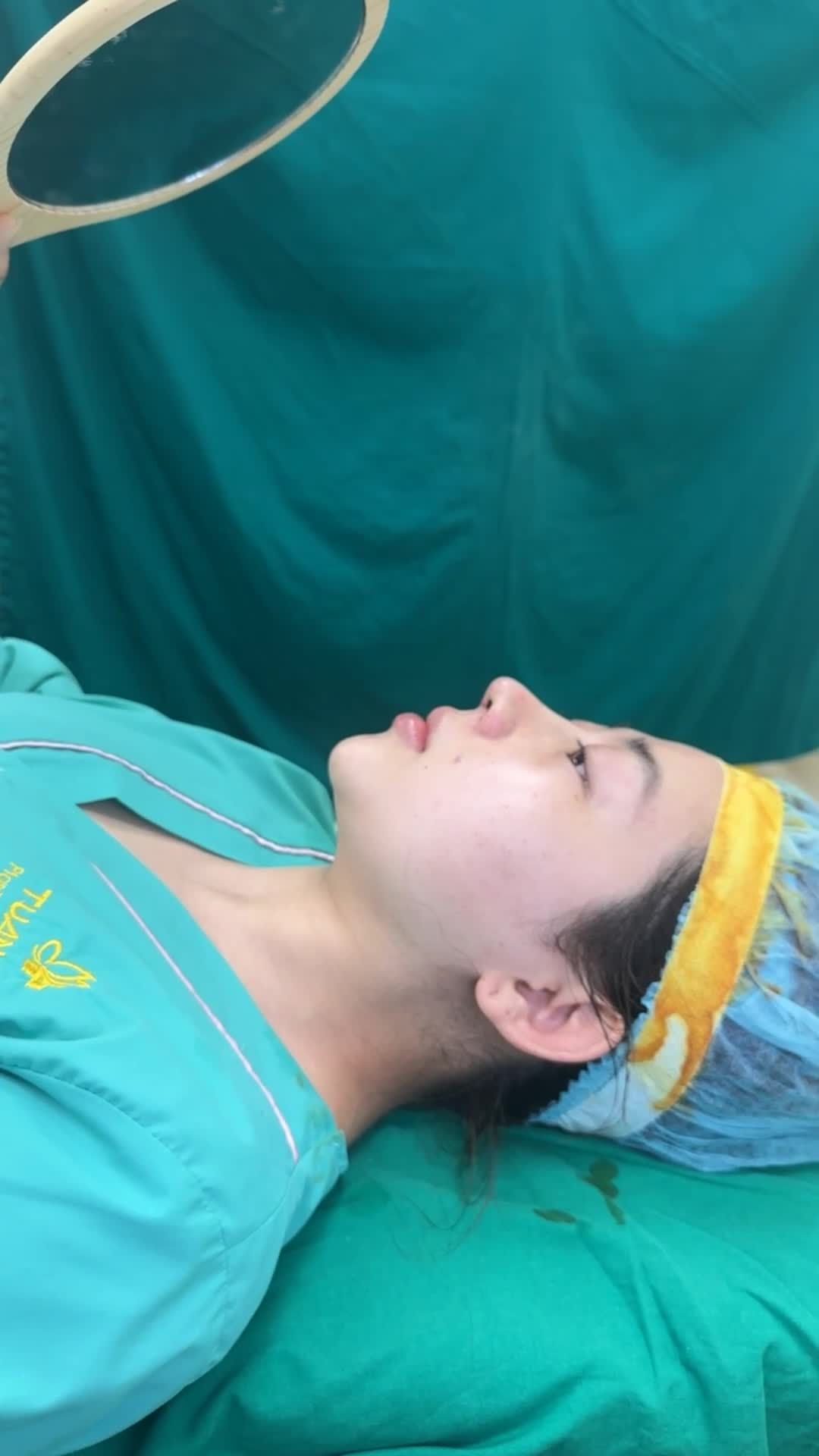 Case Mũi cấu trúc Surgiform vừa hoàn thành - Dáng mũi hài hòa, tự nhiên mà vẫn thanh tú, sắc nét!!