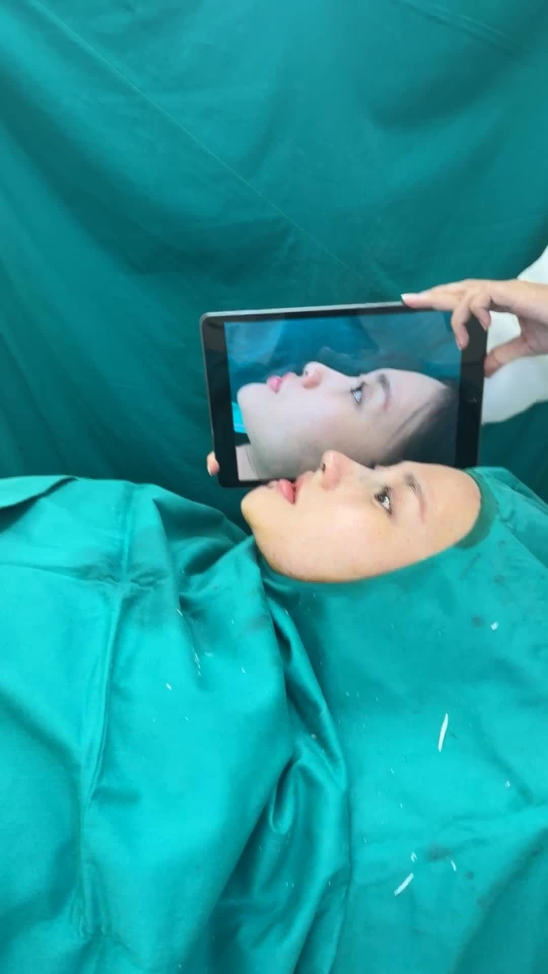 Case Nâng mũi cấu trúc kết hợp căng cơ thái dương bọc đầu mũi!!