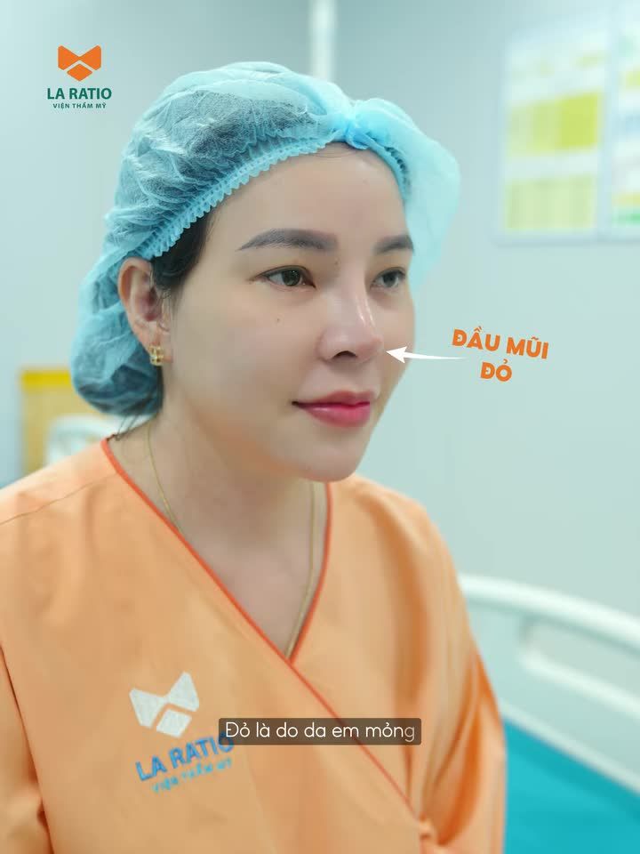 CỨU CHỮA DÁNG MŨI BIẾN CHỨNG CHO NỮ KHÁCH HÀNG