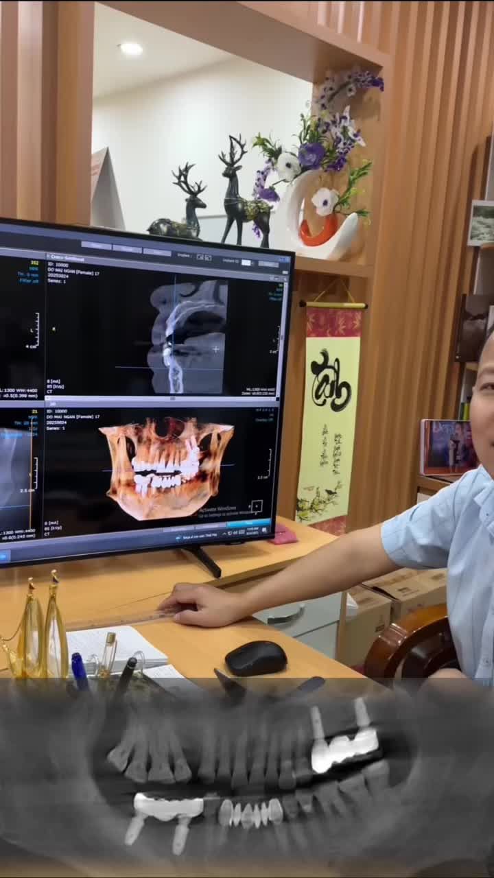 TÌNH THÂN GỬI TRỌN TRONG NỤ CƯỜI - BÁC SĨ ĐỖ HẢI ĐĂNG CẮM TRỤ IMPLANT CHO BỐ RUỘT