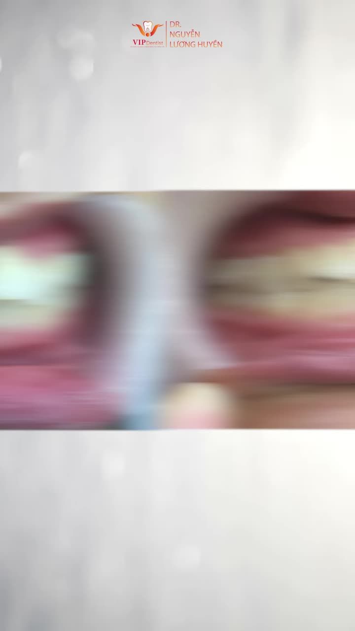 Chị Phạm Thị Tuyết trước khi đến VIP Dentist gặp phải tình trạng: Răng hô chìa Sai khớp cắn