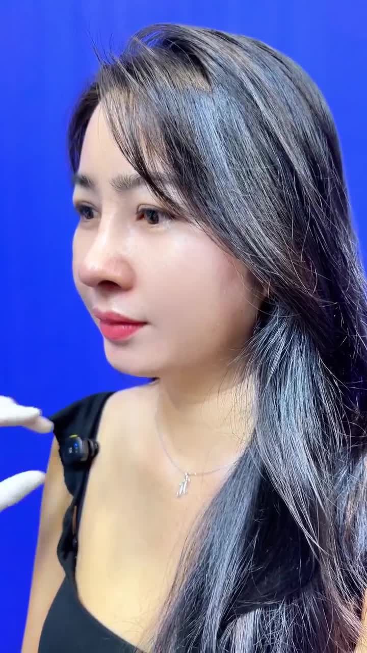 Chỉ 15 ngày sau khi thực hiện nâng mũi tại Bệnh viện Thẩm mỹ Gangwhoo, chị khách hàng đã quay lại tái khám với kết quả khiến ai nhìn cũng phải trầm trồ.