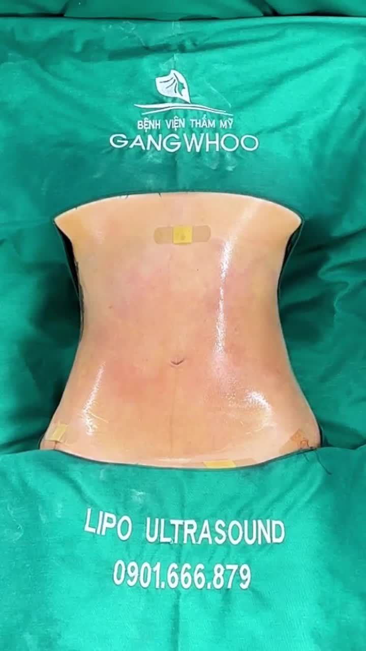 LẤY LẠI BODY THON GỌN CHO MẸ 2 CON VỚI LIPO ULTRASOUND