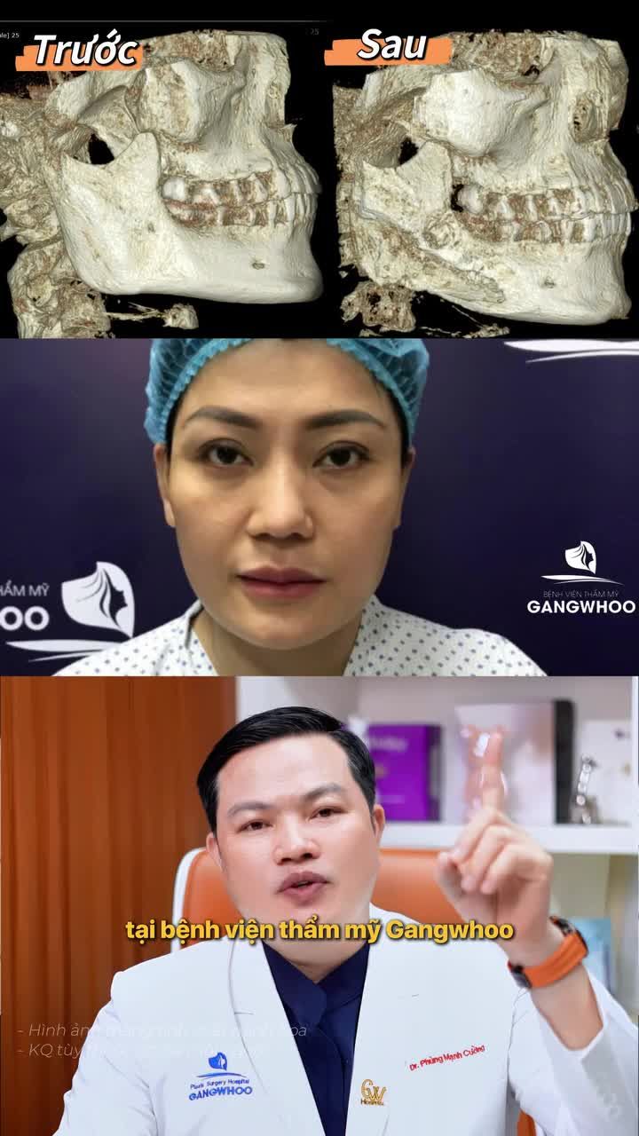 Sự khác biệt về quá trình gọt hàm nội soi vi phẫu tại BVTM Gangwhoo