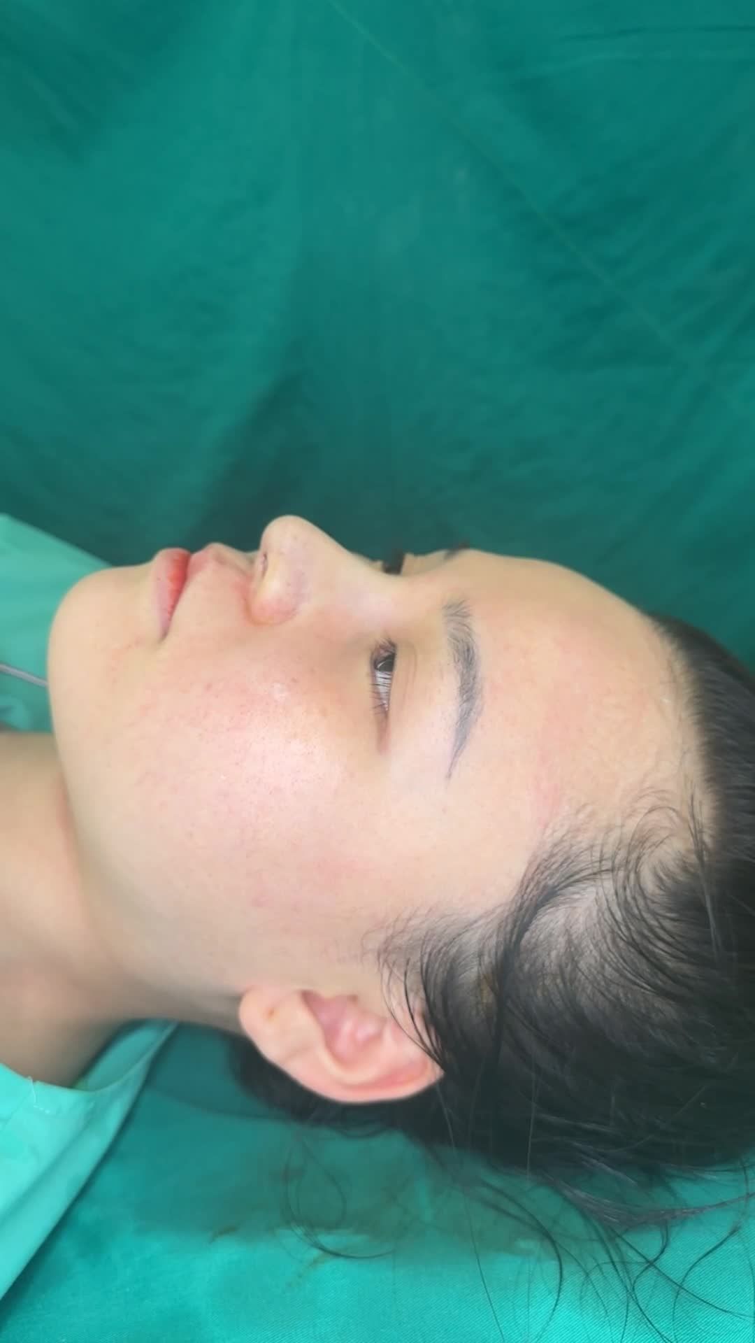Mũi bọc sụn vừa hoàn thành