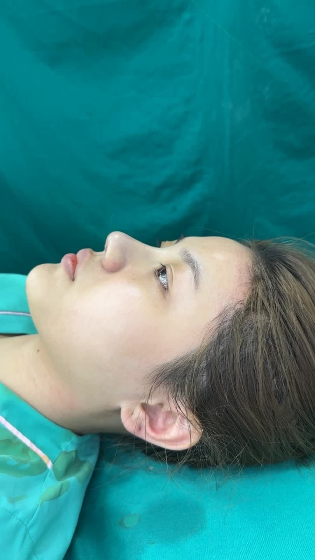 Case mũi cấu trúc vừa hoàn thành!!