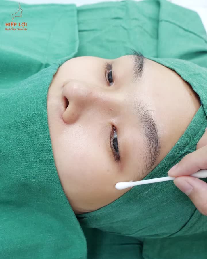 Sau khi cắt mí – đẹp liền không cần đợi! Nếp mí rõ, đều và tự nhiên ngay sau khi thực hiện