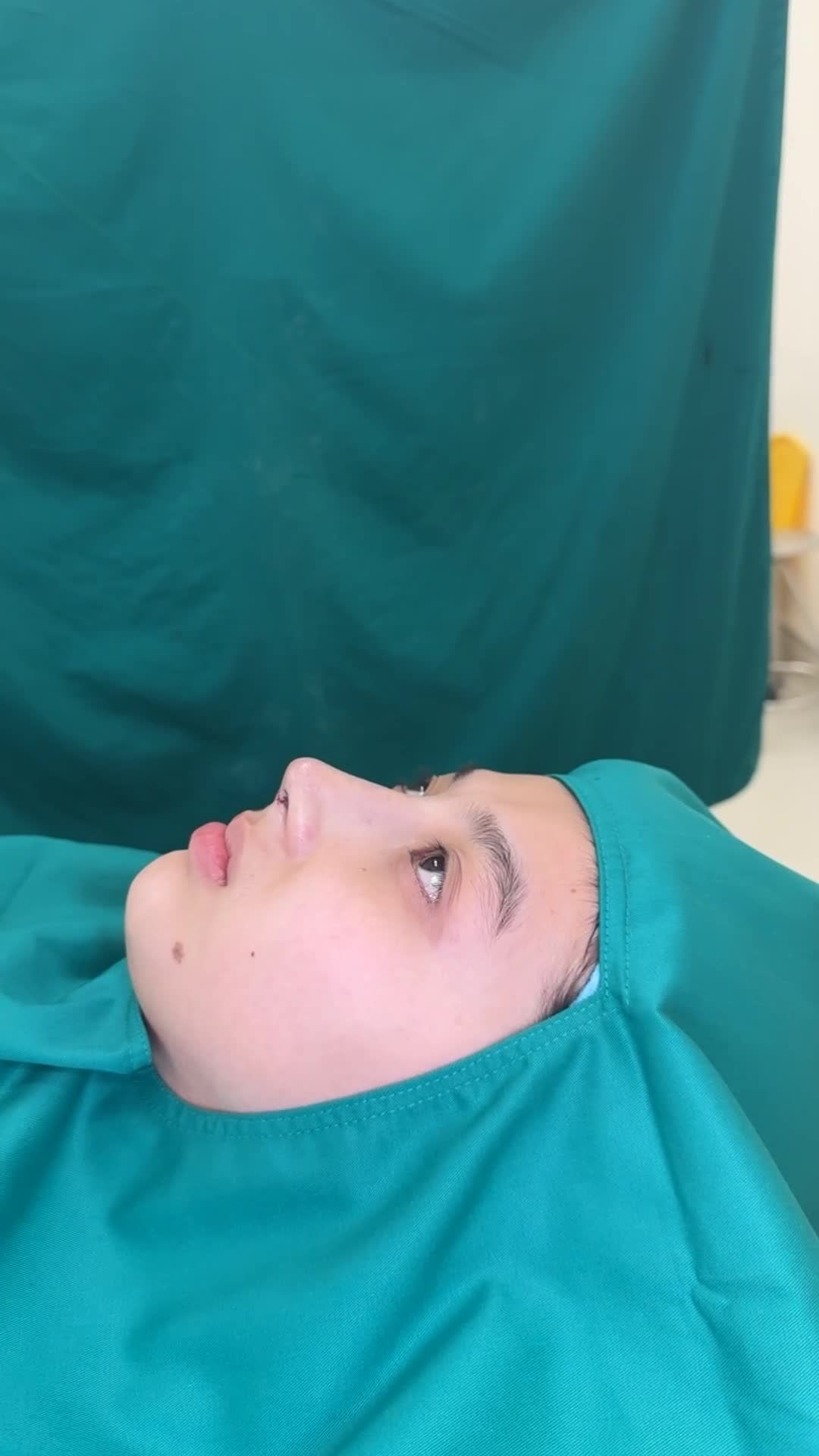 Case Mũi cấu trúc surgiform căng cơ thái dương!!
