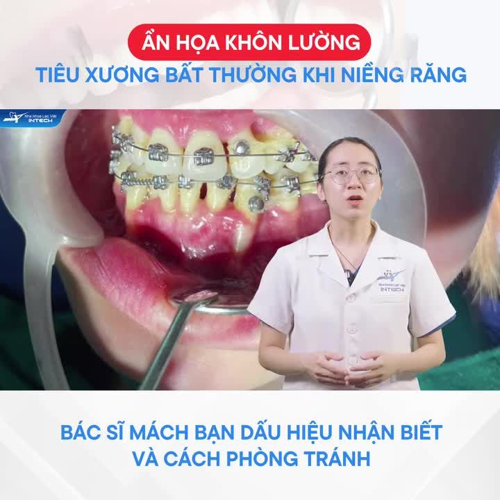 NGUY HIỂM TIÊU XƯƠNG KHI NIỀNG RĂNG – ĐỪNG CHỦ QUAN!