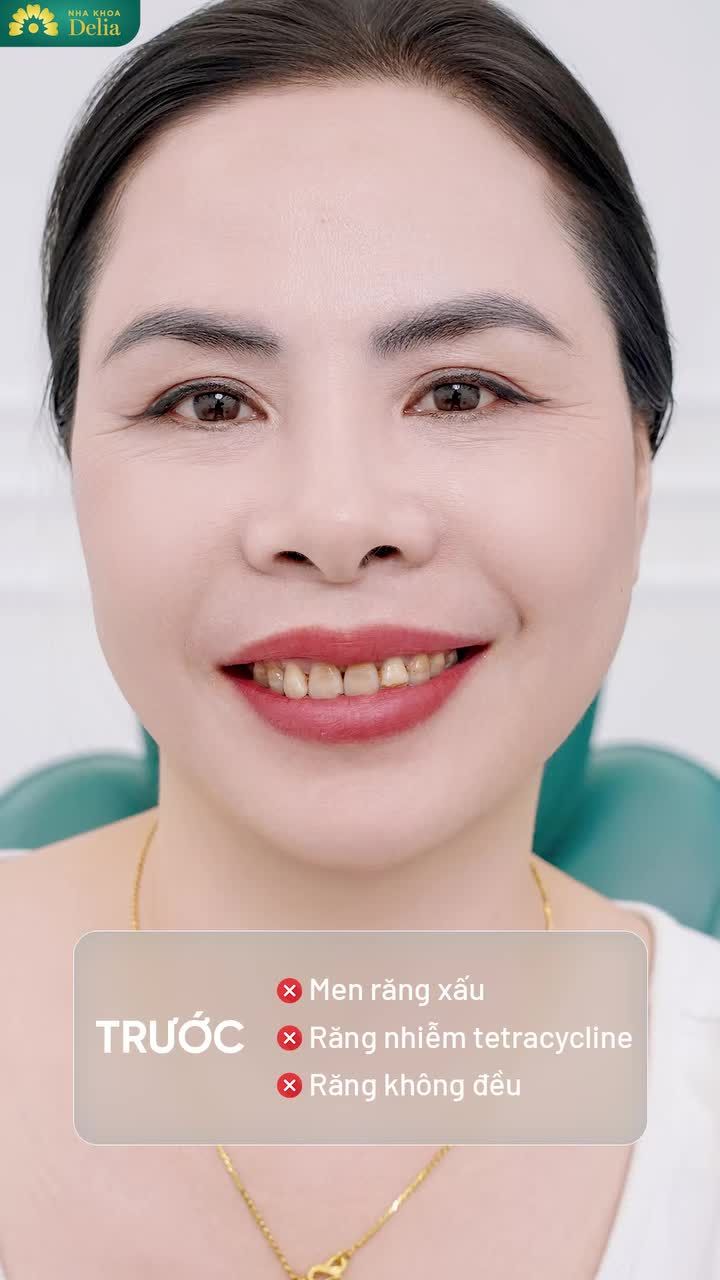 "Chị ấp ủ làm răng sứ từ lâu rồi, mà bây giờ mới thành hiện thực, mừng lắm. Răng hết nhiễm tetracycline thật rồi"