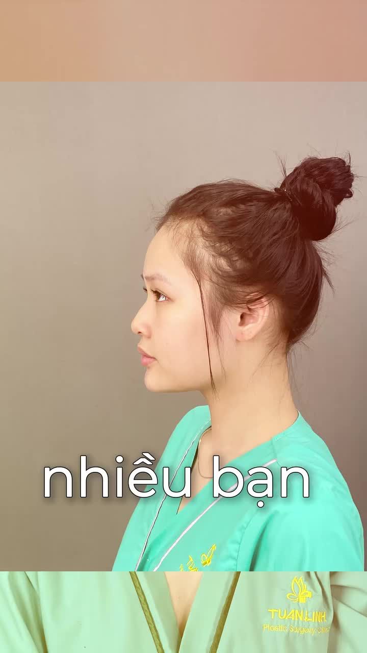 Mũi cao nhưng bị gồ, đầu mũi cụp được xử lý hoàn toàn sau 60 phút nâng mũi bọc sụn!!