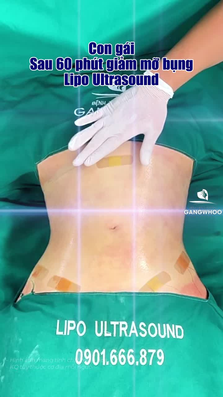 Mẹ dẫn con gái đến Gangwhoo giảm mỡ bụng Lipo Ultrasound và cái kết