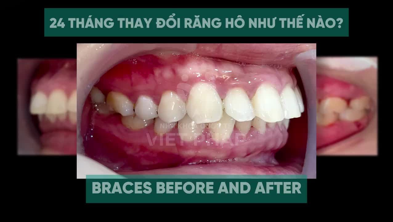 Răng hô dịch chuyển như thế nào trong 24 tháng?
