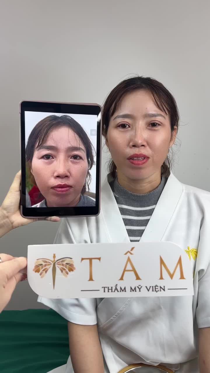Điều gì khiến Chị Hà quyết định cắt mí? Cùng lắng nghe chia sẻ thật lòng từ chị nhé