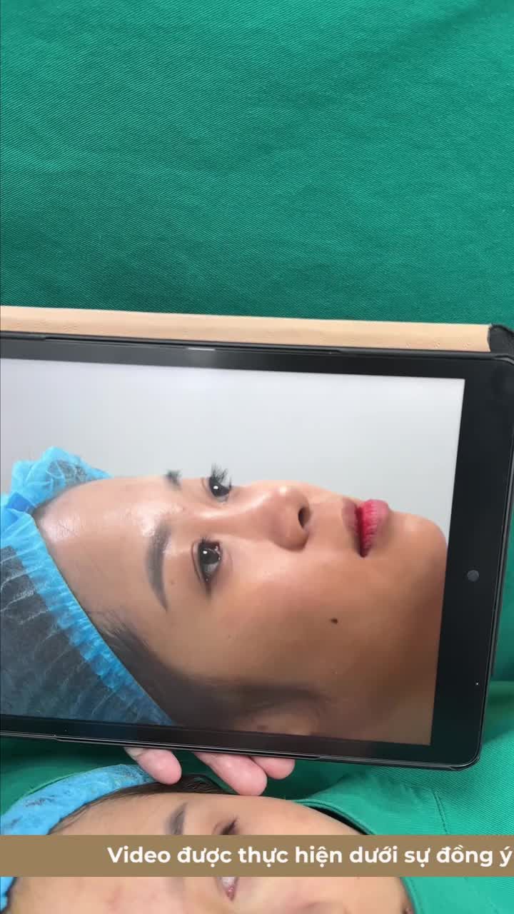Từng tiêm filler ở nơi khác nhưng chưa ưng ý, chị Hằng đến Phòng khám để khắc phục khuyết điểm.