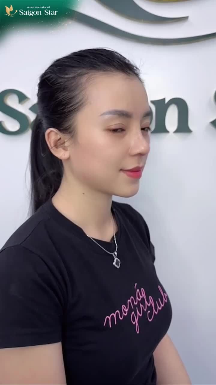 BỎ LẠI CHIẾC MŨI CŨ - EM GÁI BÌNH DƯƠNG ĐÓN DÁNG MŨI MỚI TẠI DR.HOẠT