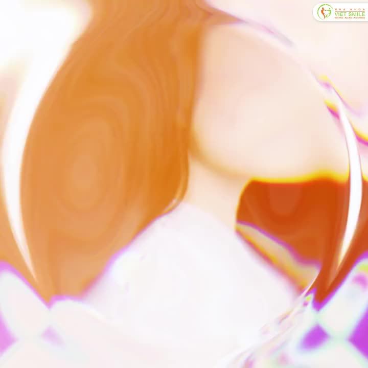 Sau khi tháo niềng 1 năm, cô nàng Thuý Linh quay lại Viet Smile tái khám với nụ cười rạng rỡ, hàm răng đều đẹp và khớp cắn vẫn chuẩn như ngày đầu kết thúc hành trình chỉnh nha.