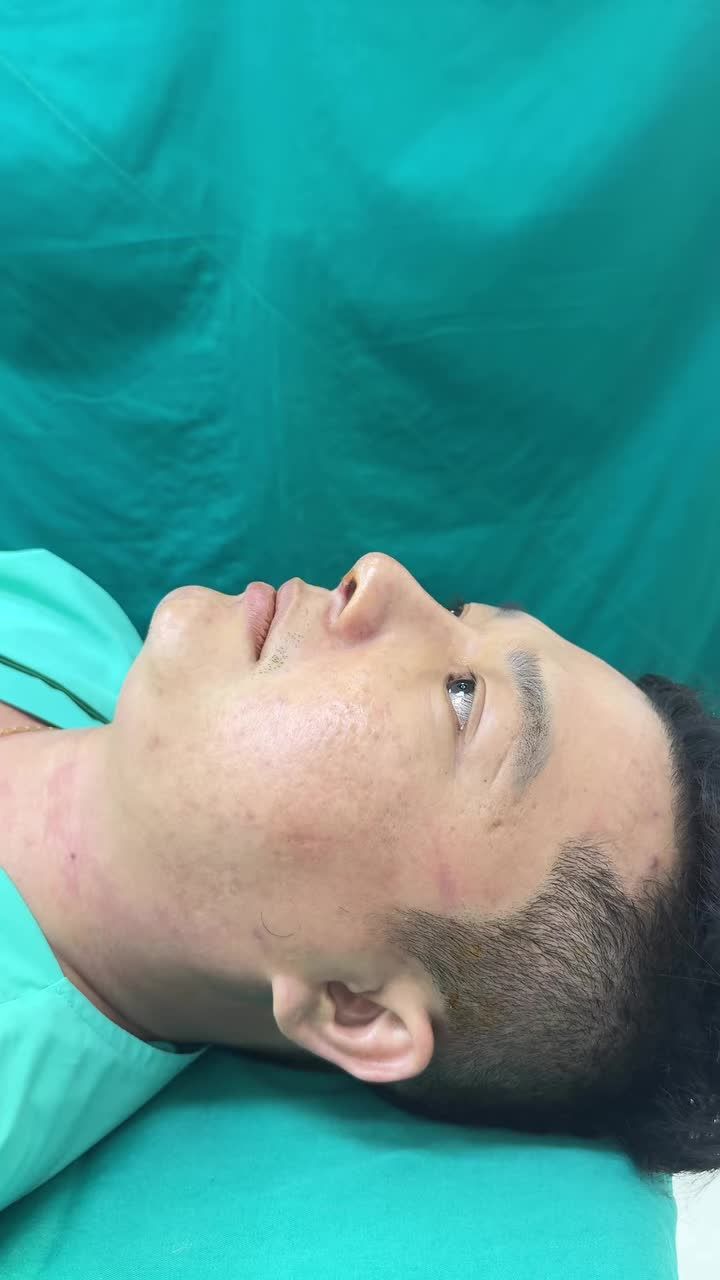 Case độn cằm sụn mỹ vừa hoàn thành