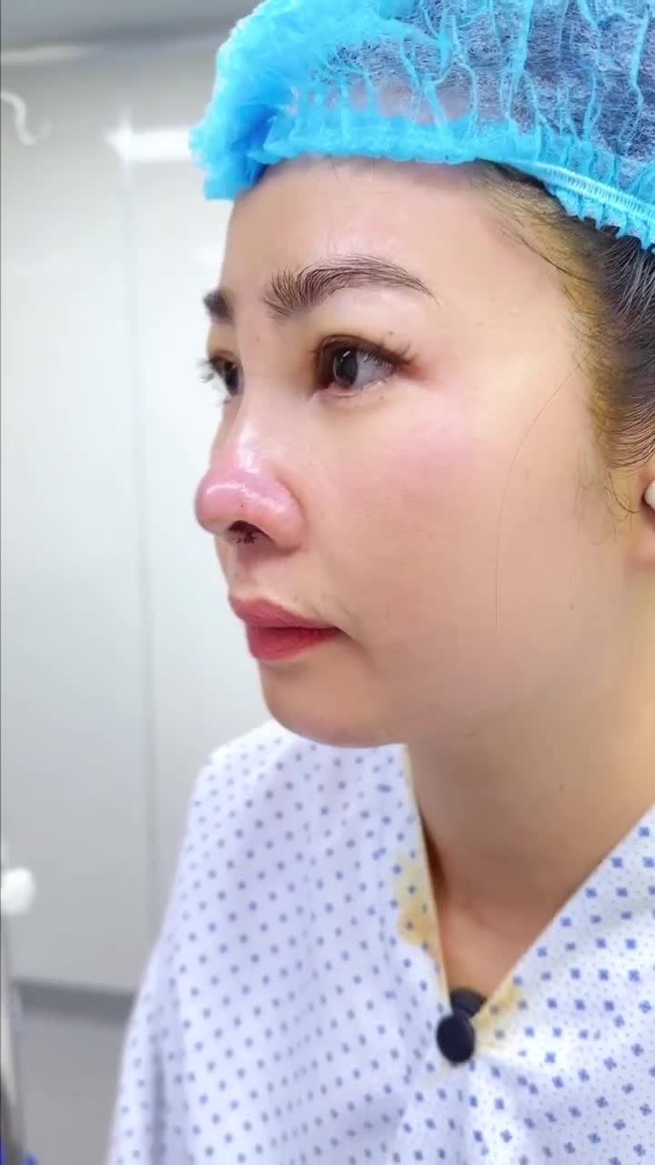 CÔ GÁI 26 TUỔI LÊN ĐỜI NHAN SẮC SAU 60 PHÚT NÂNG MŨI TẠI BỆNH VIỆN THẨM MỸ GANGWHOO – DÁNG MŨI L-LINE, GƯƠNG MẶT SẮC SẢO!