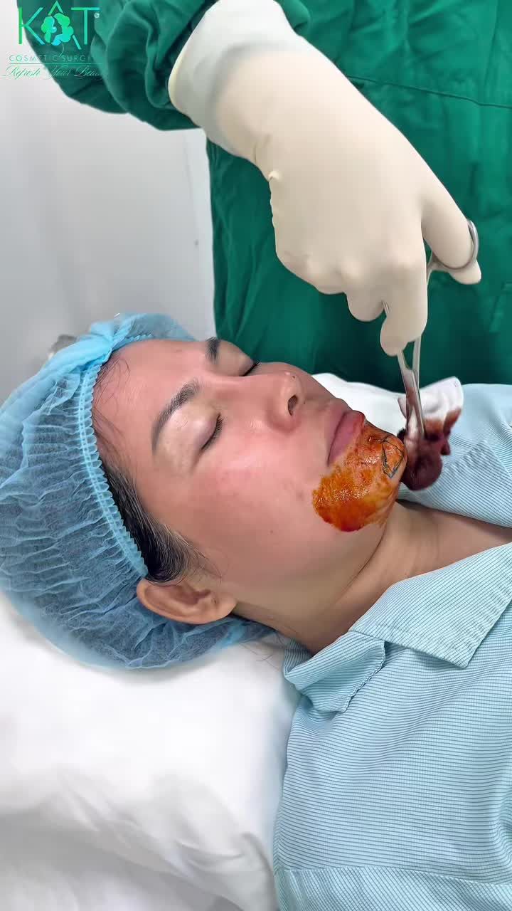 Hành trình chạm tới chiếc cằm V-line chuẩn tỉ lệ Độn cằm tự nhiên – không lộ – không sưng lâu!