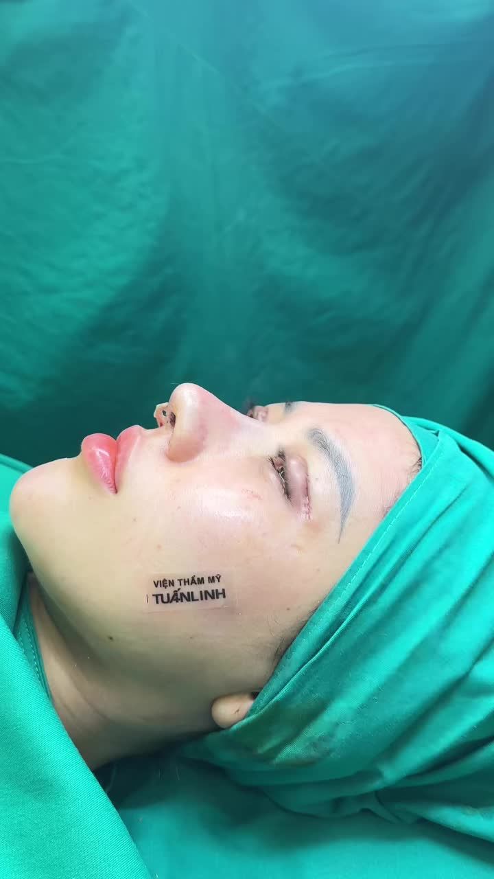Case mũi cấu trúc sửa lại + cắt mí