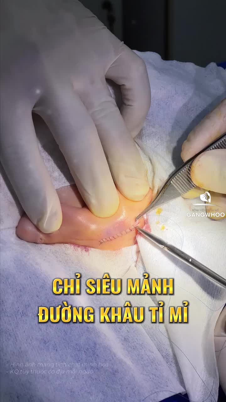 Cận cảnh khâu vi phẫu tai sau khi lấy sụn nâng mũi