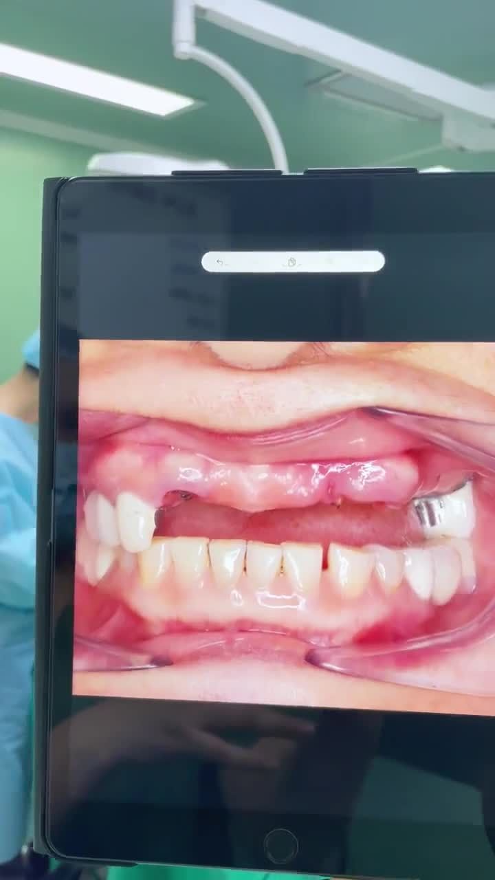 TOÀN CẢNH Bác sĩ JW trực tiếp Trồng răng Implant giúp bà ngoại U70 ĂN THOẢI MÁI, CƯỜI TỰ TIN ở tuổi xế chiều