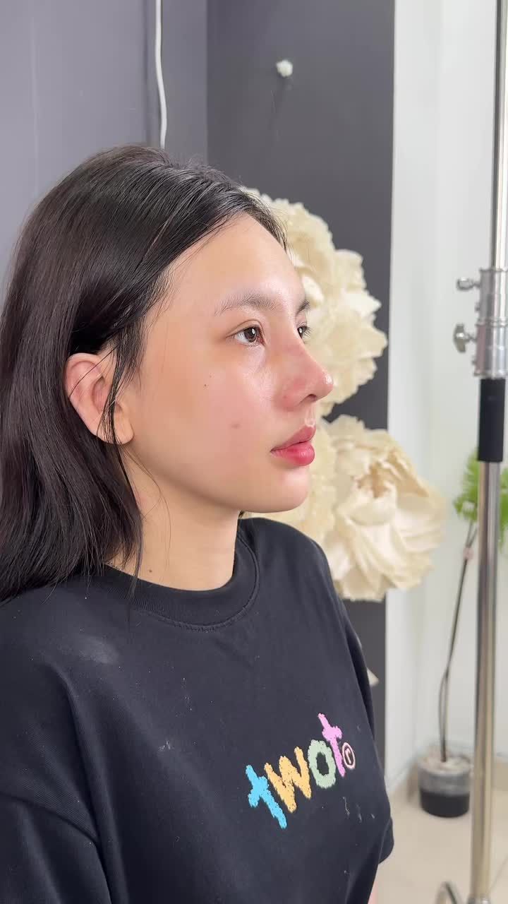 Case mũi cấu trúc surgiform được 10 ngày - Dáng mũi ôm form chuẩn dáng!!
