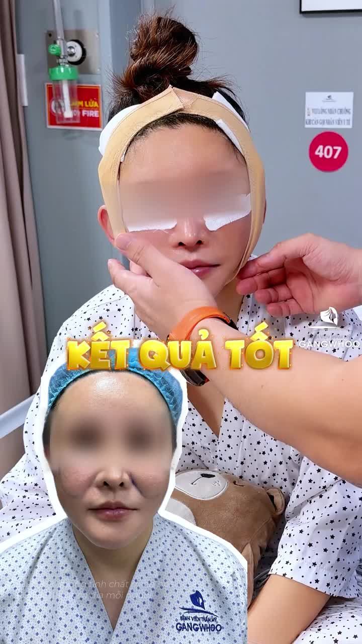 Kết quả thay đổi rõ sau khi căng da mặt Smas nội soi 4K
