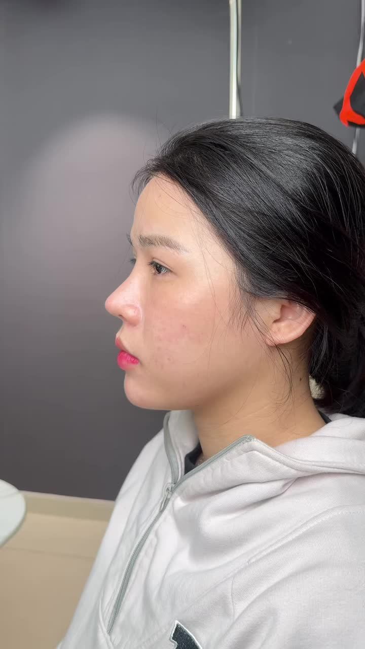 Tái khám mũi bọc sụn sau 1 tháng