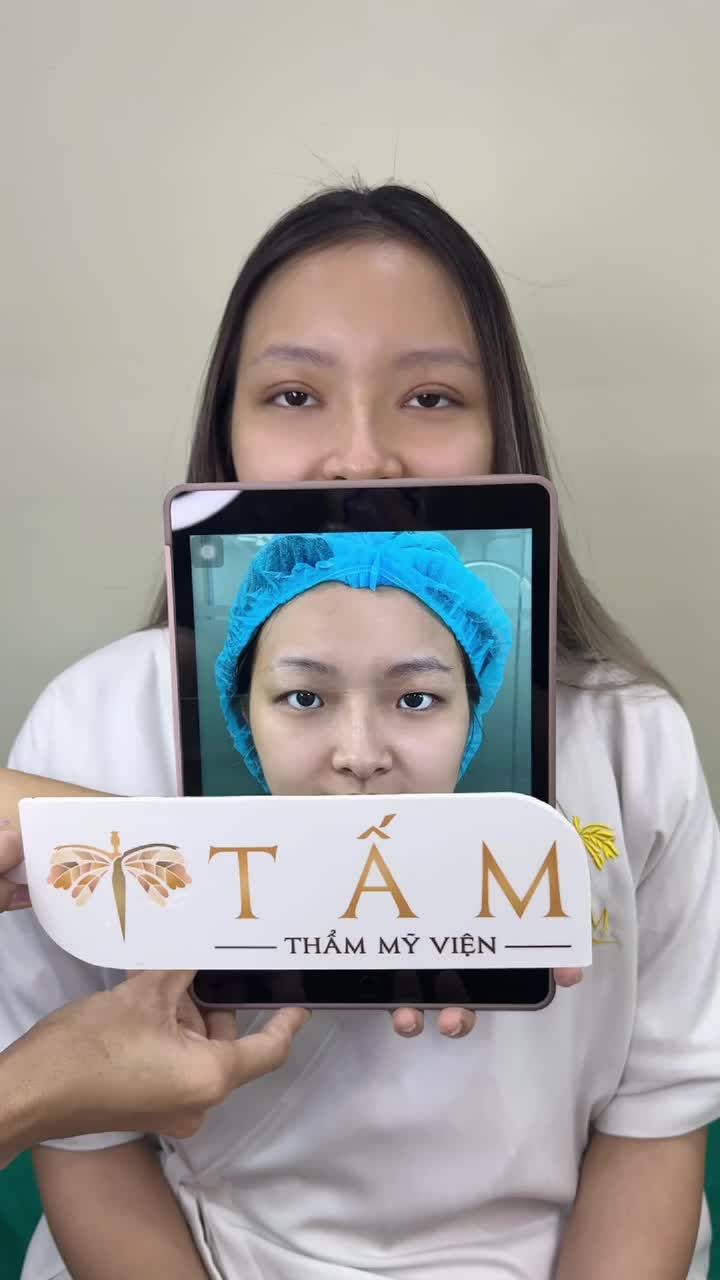 Một lần cắt mí chơi chơi, ai ngờ trẻ đẹp rạng ngời thanh xuân