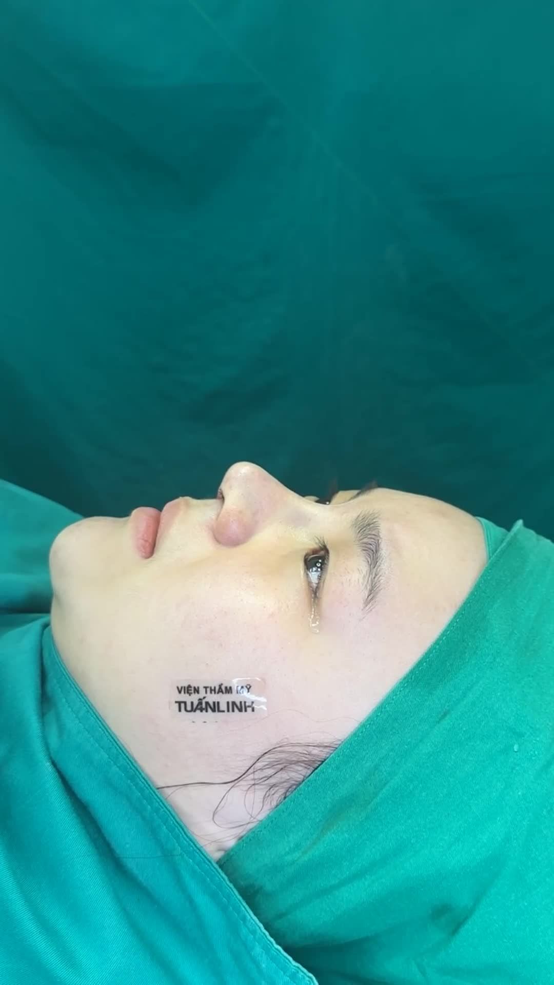 Case Mũi cấu trúc surgiform - Dáng mũi thiết kế theo tỉ lệ gương mặt!!