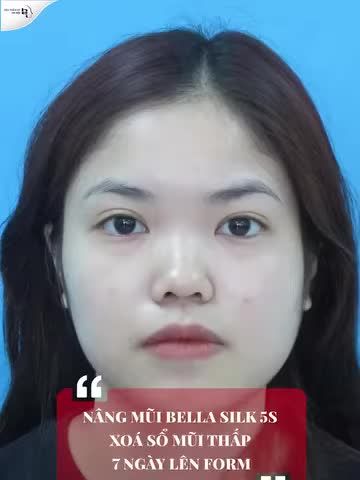 LỘT XÁC THÀNH HOTGIRL CHỈ SAU 30P THỰC HIỆN NÂNG MŨI BELLA SILK 5S