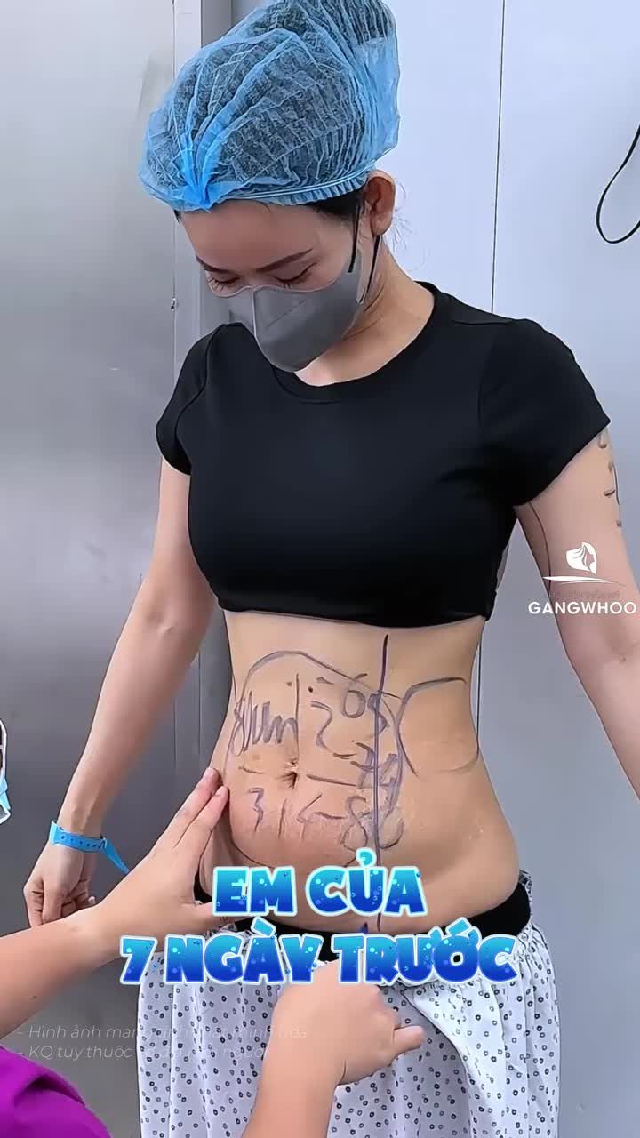 Em của 7 ngày trước và sau khi giảm mỡ tại BVTM Gangwhoo