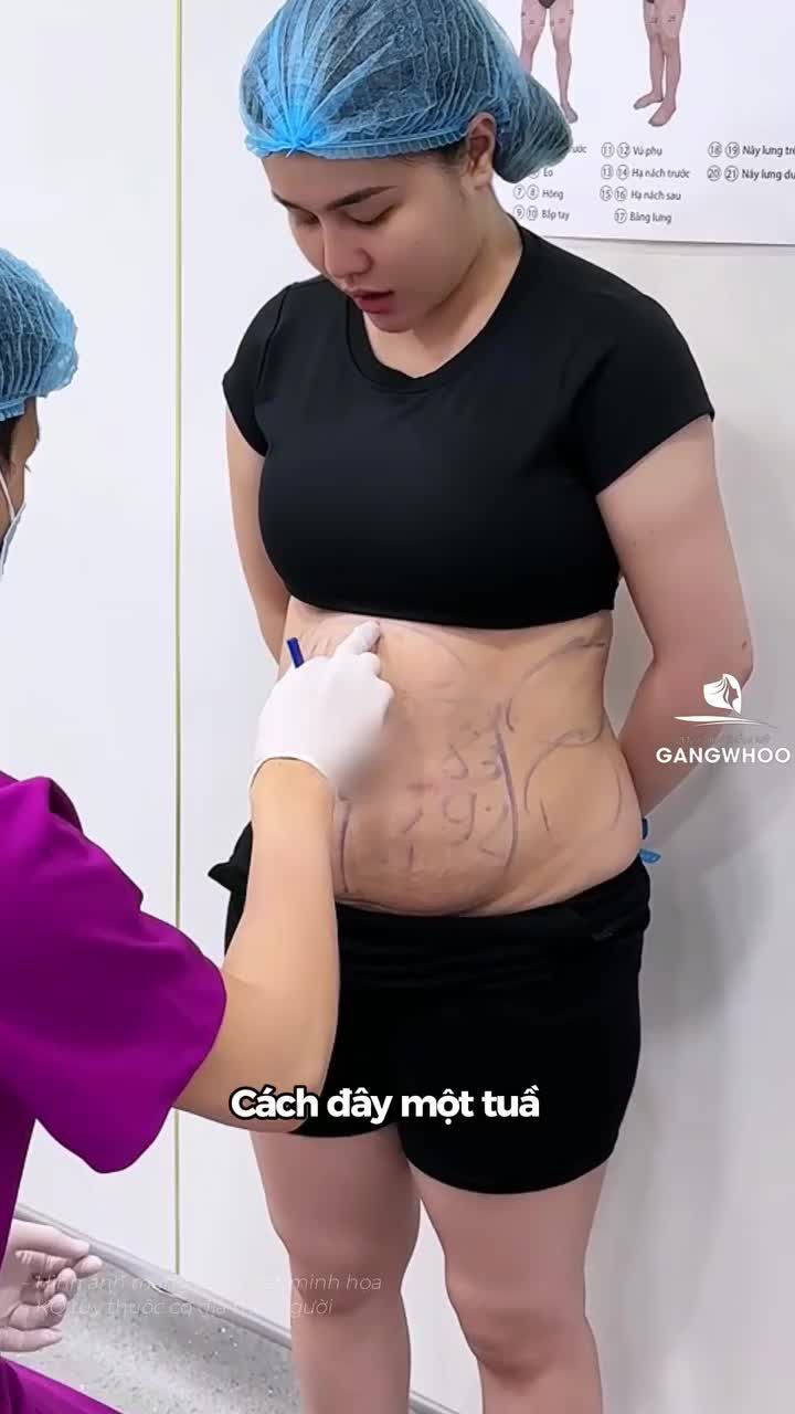 Check var vòng eo 68cm của chị khách sau 7 ngày giảm mỡ Lipo Ultrasound
