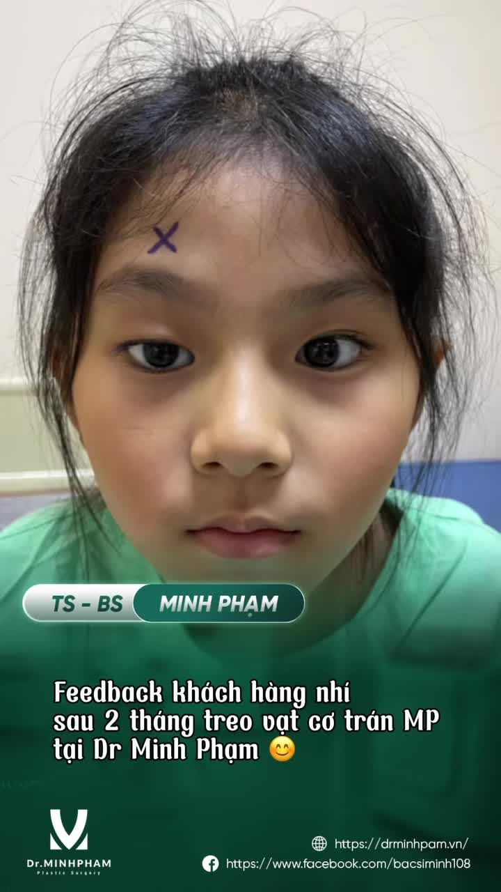 Feedback khách hàng nhí sau 2 tháng treo vạt cơ trán mắt phải tại Dr. Minh Phạm