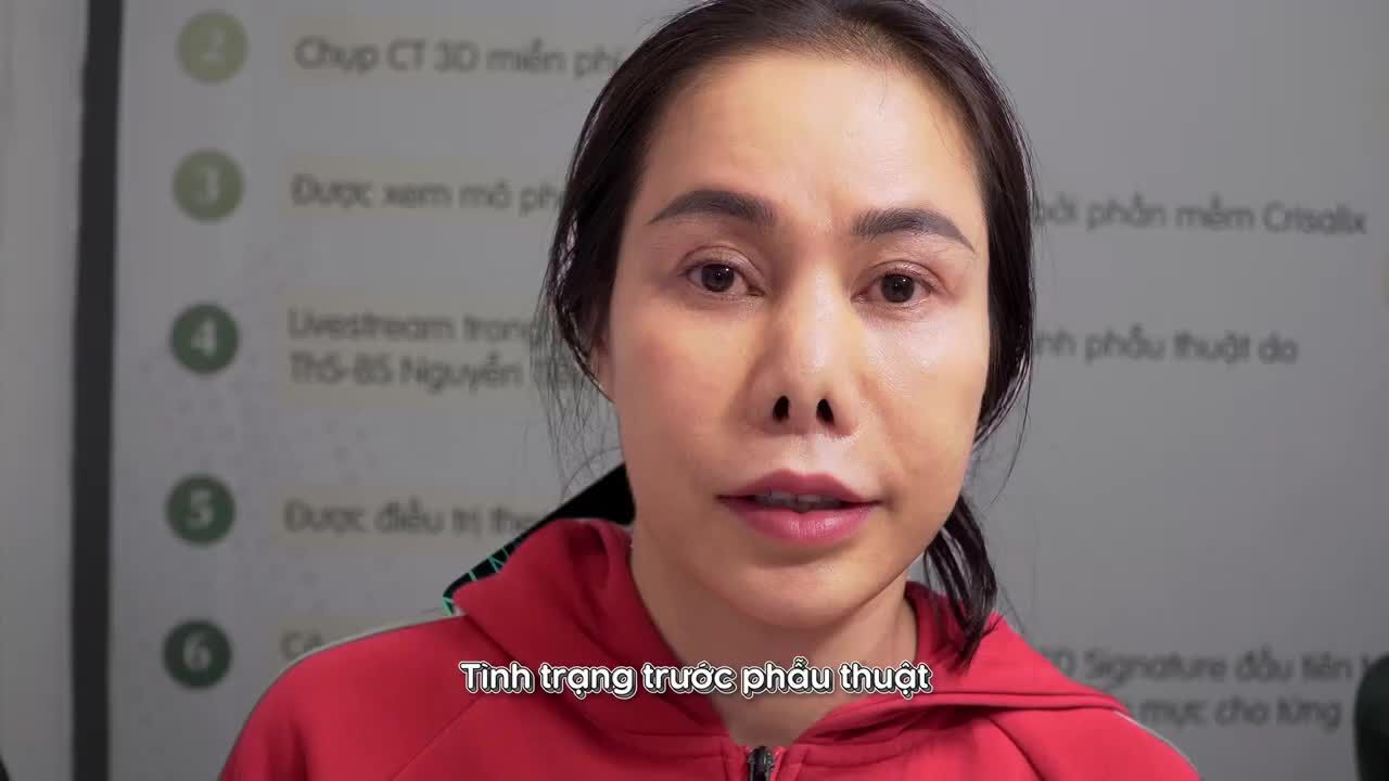 VÌ SAO ĐÃ NÂNG MŨI SỤN SƯỜN NHƯNG KẾT QUẢ VẪN KHÔNG NHƯ Ý?