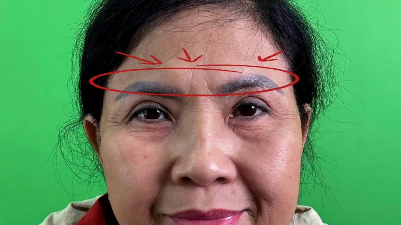 TRẺ HÓA VÙNG MẮT, LẤY LẠI THẦN THÁI VỚI TREO CUNG MÀY