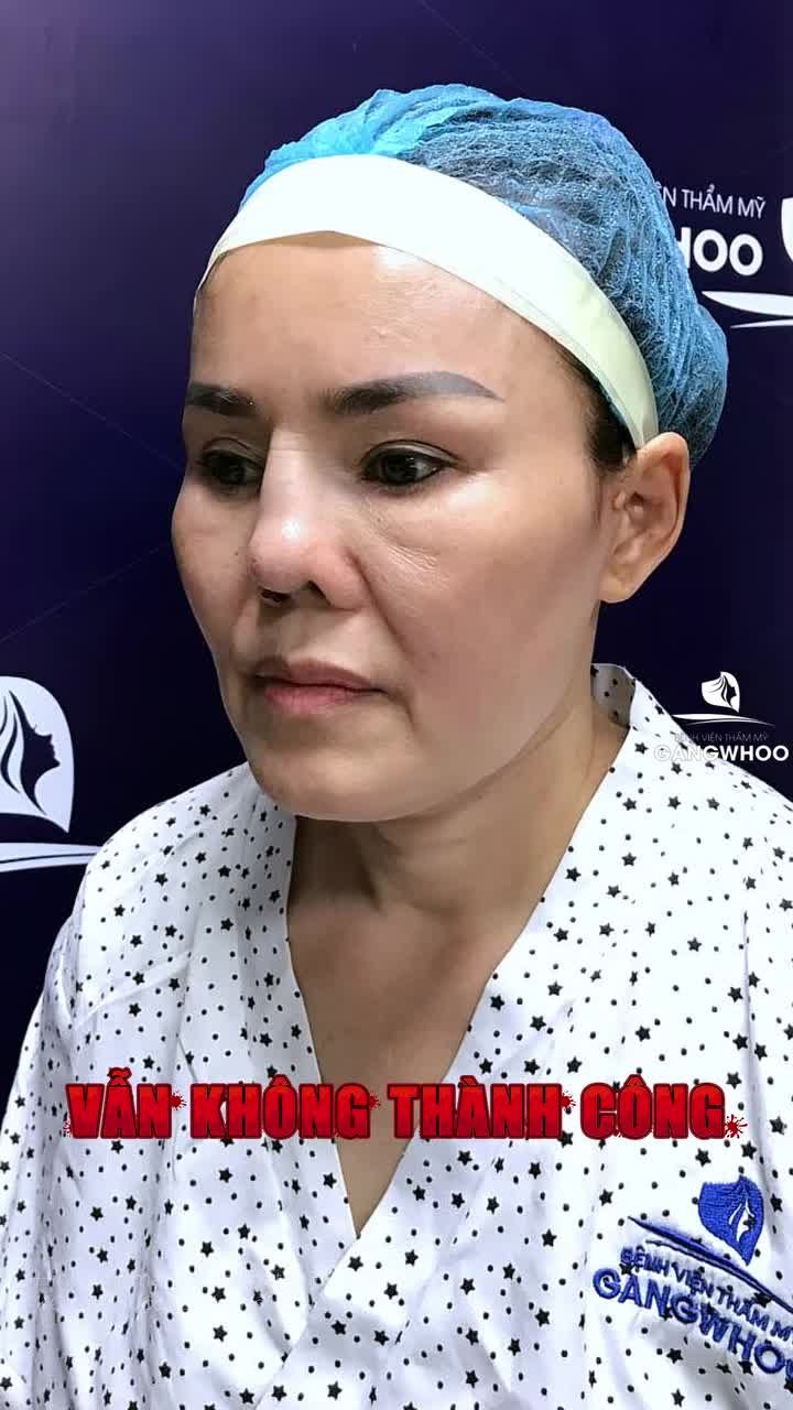 Chiếc mũi bị nhận xét "giống lợn" sẽ như thế nào sau khi đến BVTM Gangwhoo