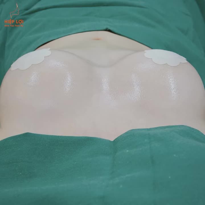 KHUYẾN MÃI ĐẶC BIỆT – NÂNG NGỰC CHUẨN ĐẸP CHỈ 45 TRIỆU!