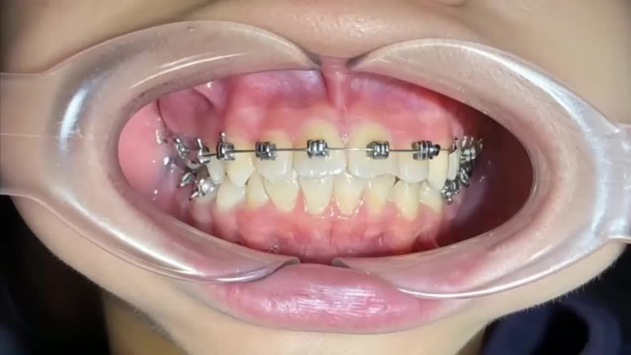 chỉnh nha mắc cài