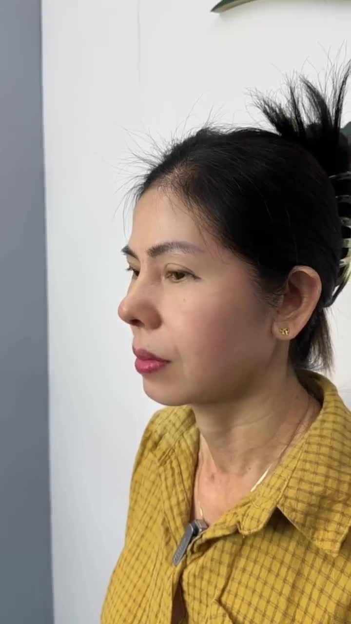 SAU 10 NGÀY NÂNG MŨI CẤU TRÚC CÙNG DR. HOẠT