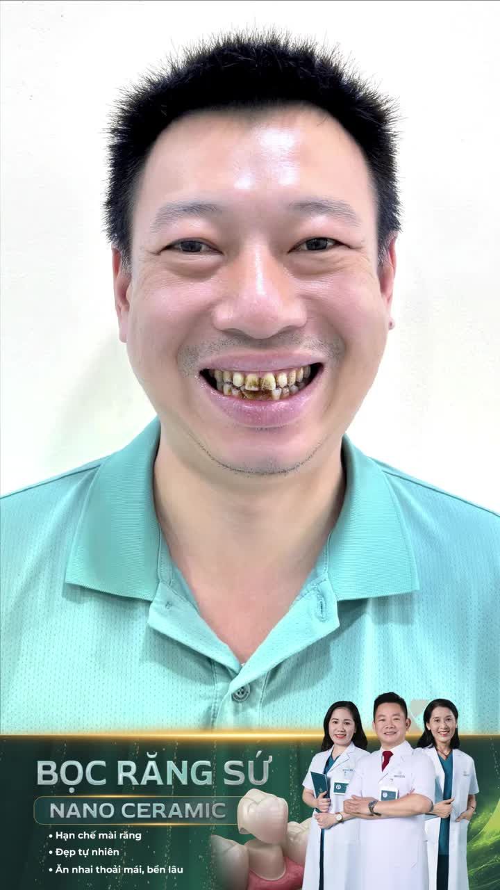 Lấy lại nụ cười phong độ sau bọc răng sứ Dr. Mậu