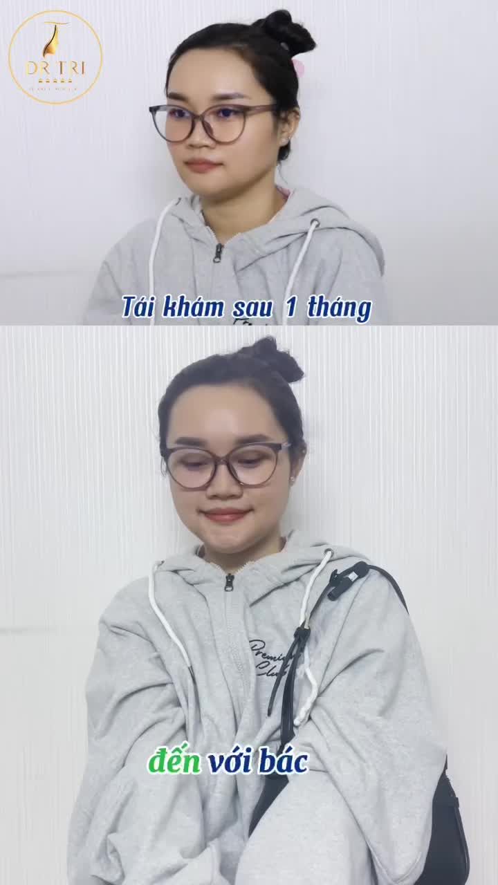 Cảm Nhận Chân Thật Sau Gọt Hàm tại Dr. Trí: