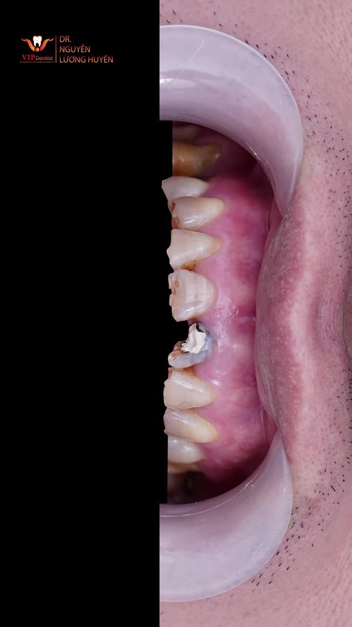 Trước khi đến với VIP Dentist, anh Hồng Thái từng gặp rất nhiều vấn đề về răng: